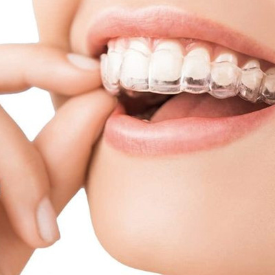 Themenbild Unsichtbare Zahnspangen